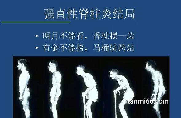 强直性脊柱炎有哪些症状能治好吗，会全身关节疼痛(不死癌症)