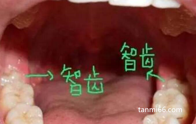 智齿到底应不应该拔掉，三张不需要拔的智齿图片告诉你答案